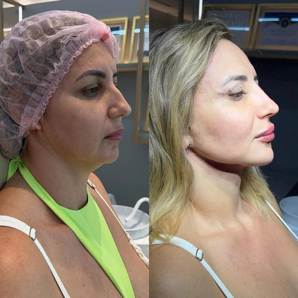Antes e depois de tratamento com bioestimulador de colágeno