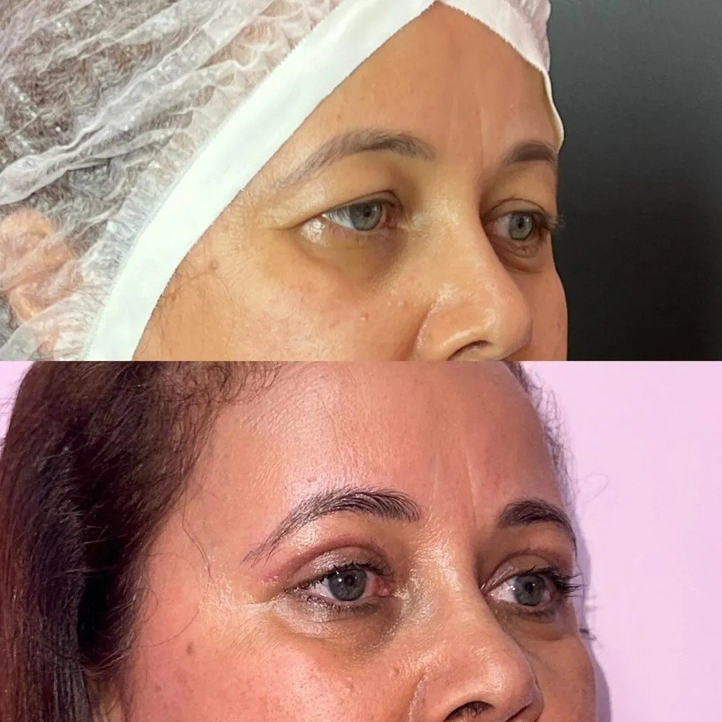 Antes e depois de blefaroplastia
