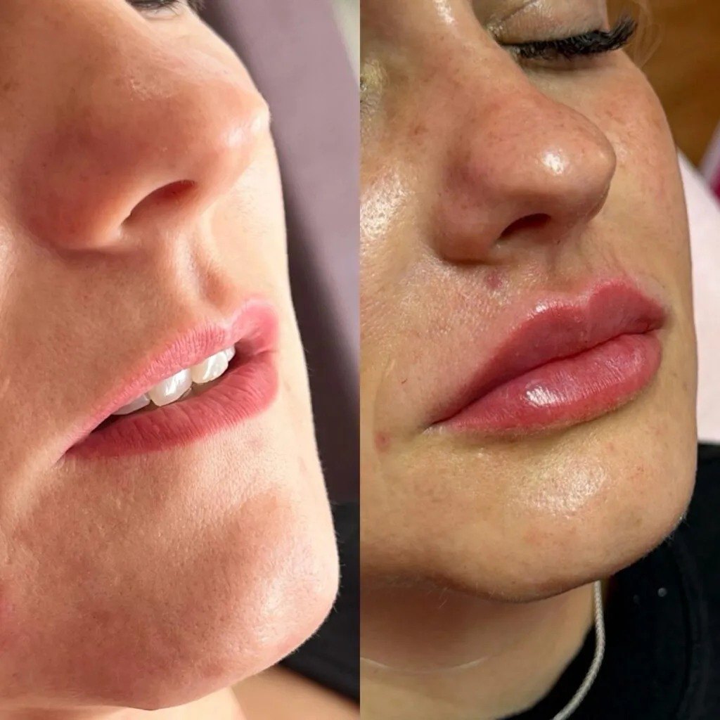 Antes e depois de harmonização facial nos lábios