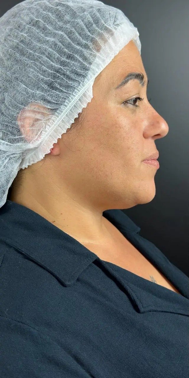 Antes da platismoplastia, caso 1