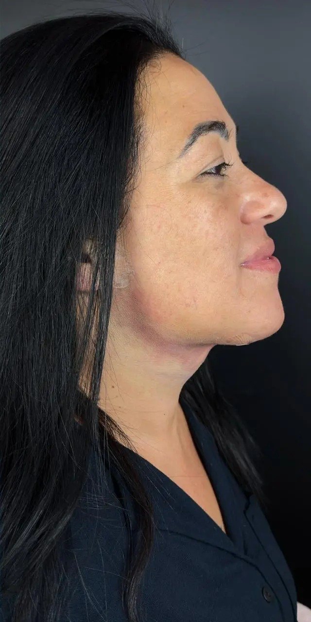 Depois da platismoplastia, caso 1