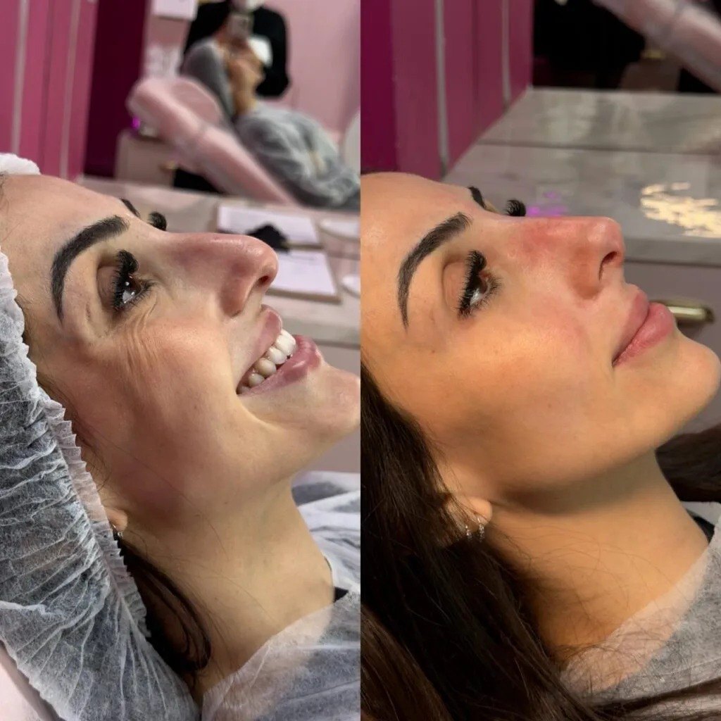 Antes e depois de rinomodelação